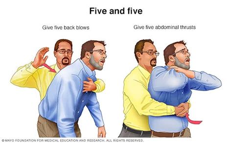 Relief of Choking