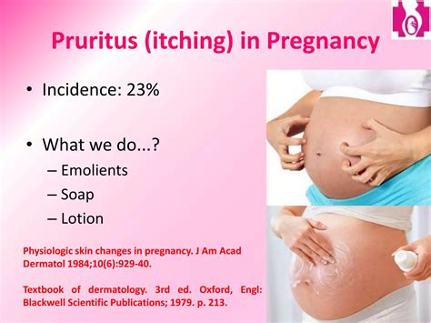 Cholestasis of pregnancy management