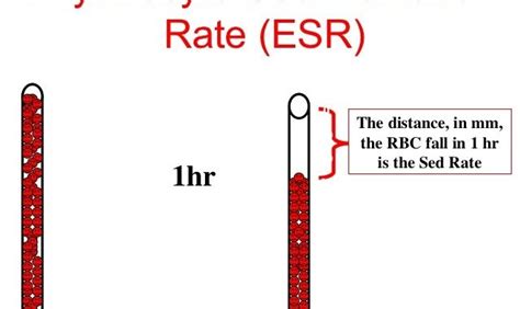 Clinical applications of ESR by modified Westergren