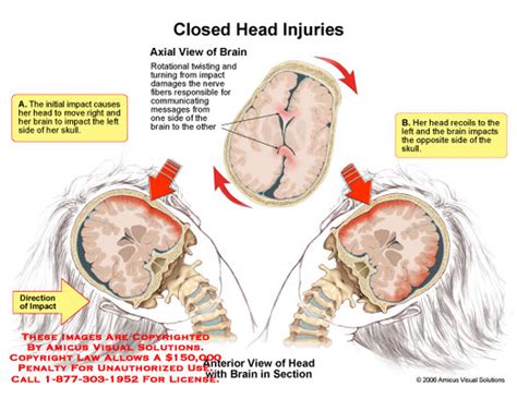 Closed Head Injury