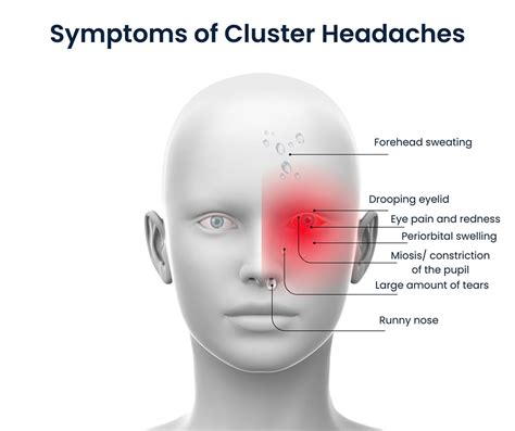 Cluster Headaches