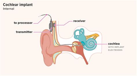 Cochlear implant techniques