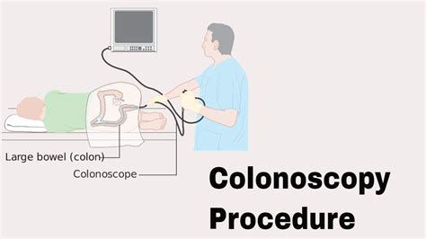 Colonoscopy Steps