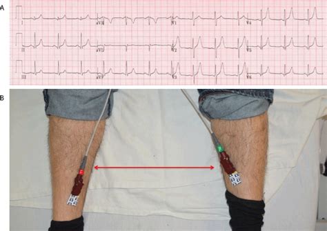Common Mistakes ECG Lead Placement