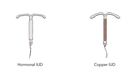 Copper IUD