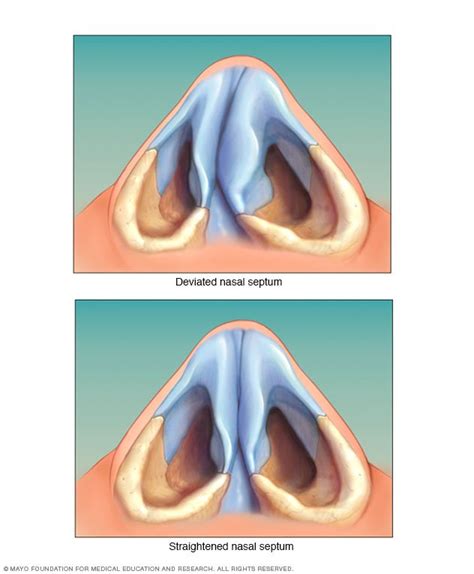 Cracked Nose Medical Attention
