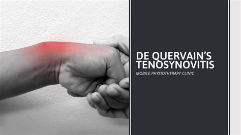 De Quervain's tenosynovitis illustration