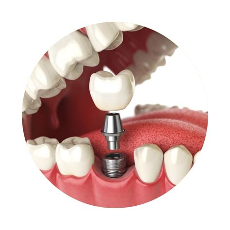 Dental Implants