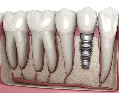 Dental Implants