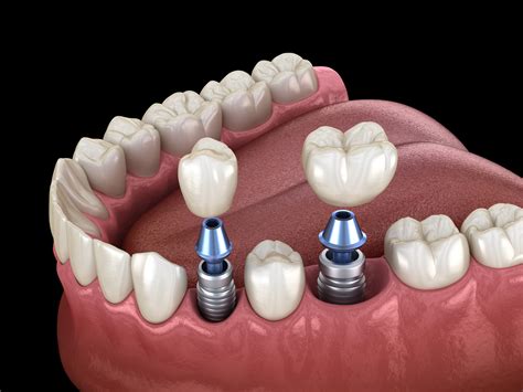 Dental Implants at West Seattle Dental Center