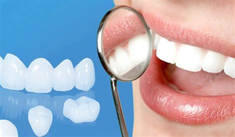 Dental Veneers