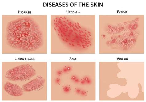 Dermatological Symptoms