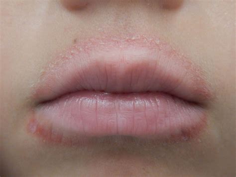 Diagnosing rash around mouth