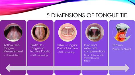 Diagnosing Tied Tongue