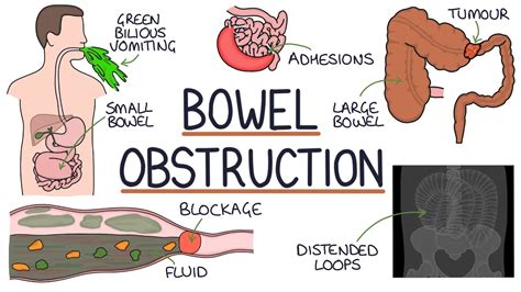 Diagnosis and Treatment of Bowel Obstruction