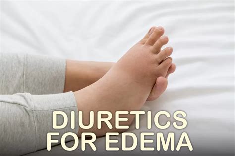 Diuretics for Edema