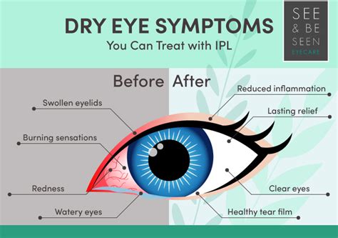 Dry Eye Treatment