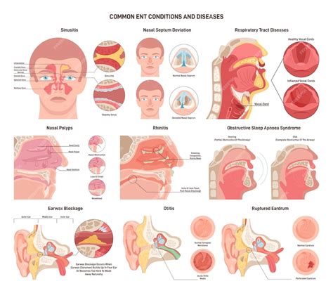 Ear, Nose, and Throat Infections