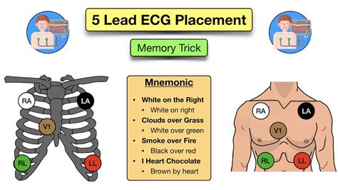 EKG lead placement diagram