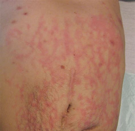 Erythema Ab Igne