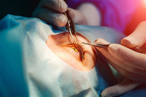 Kaiser Moreno Valley Iris Surgery Options