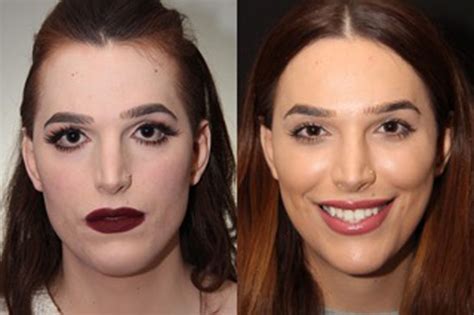 Facial Feminisation Surgery