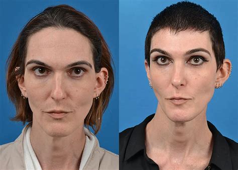 Facial Feminisation Surgery Recovery