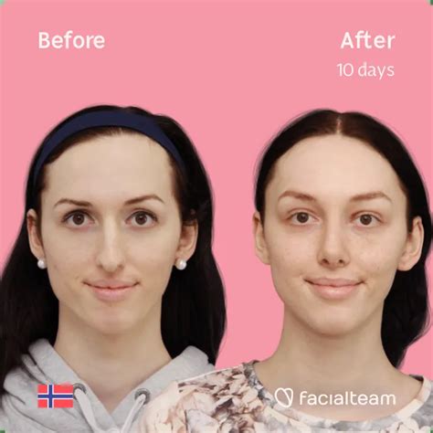 Facial Feminisation Surgery Results