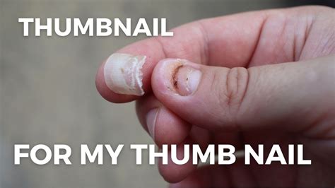 A fallen nail can be painful and frustrating