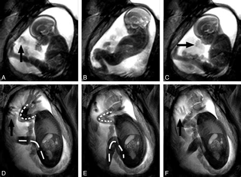 fetal movement during pregnancy