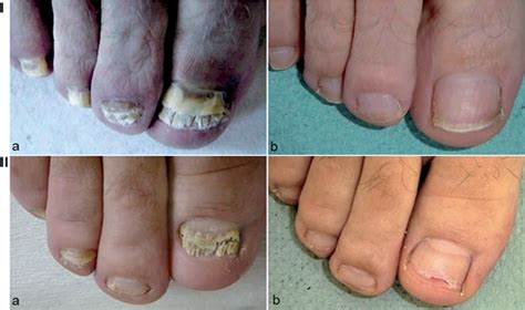Fluconazole Nail Infections