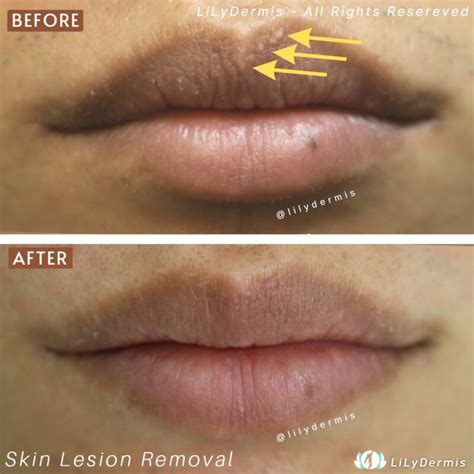 Fordyce Spots Treatment