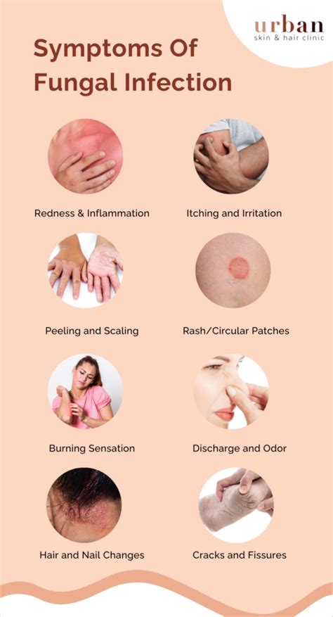 Fungal Infections