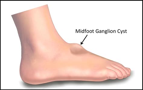ganglion cyst ankle