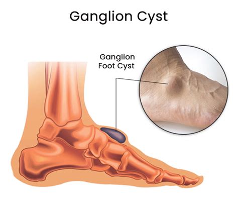 ganglion cyst ankle causes