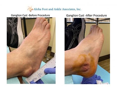 ganglion cyst ankle prevention