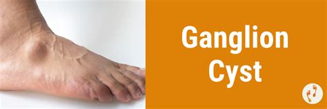 ganglion cyst ankle treatment