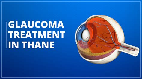 Glaucoma Treatment