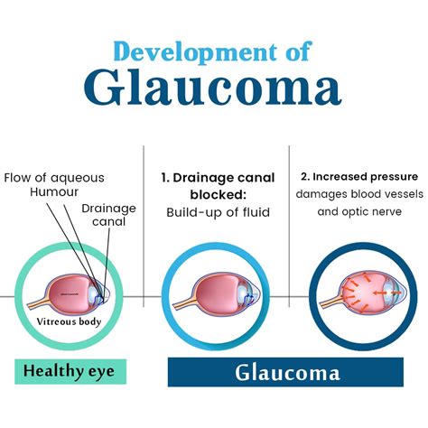 Glaucoma treatment