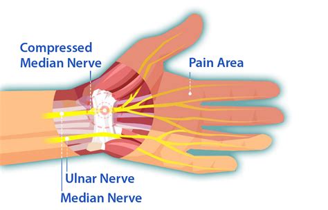 Improved hand function