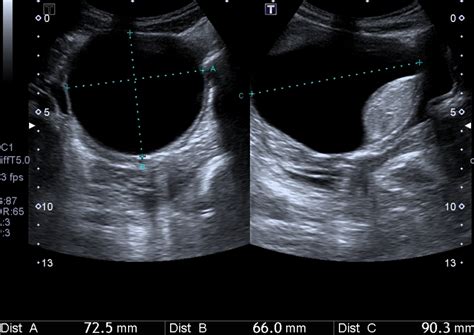 Hemorrhagic Ovarian Cysts