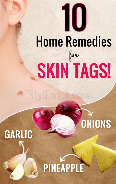 Home remedies for skin tags