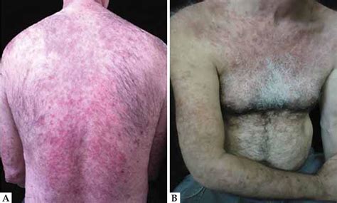 Hydralazine skin rash