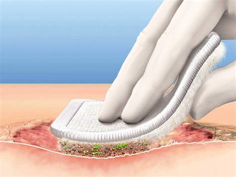 Hydrotherapy Debridement