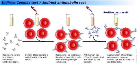 Indirect Coombs Test