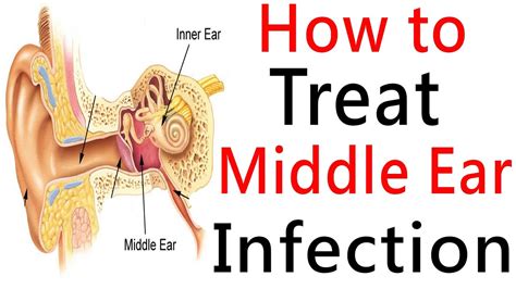 Inner Ear Infection Treatment