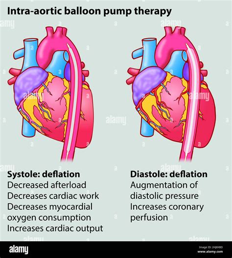Intra-aortic balloon pump therapy