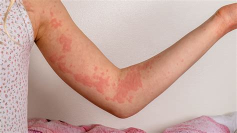 Itching and Irritation