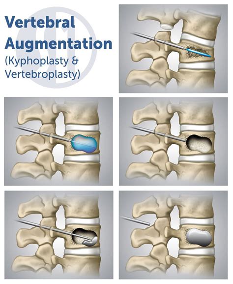 Kyphoplasty Specialist