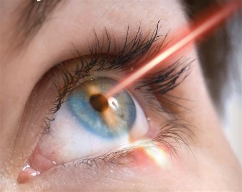 Laser Eye Surgery